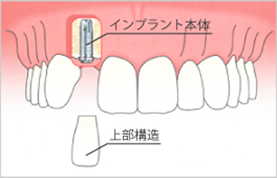 前歯に1本埋入した場合