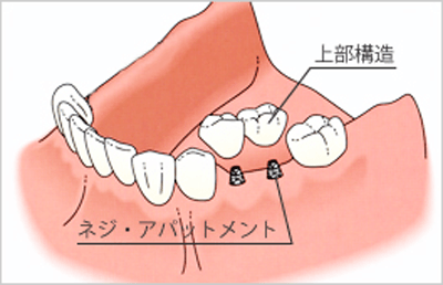 奥歯に2本埋入した場合